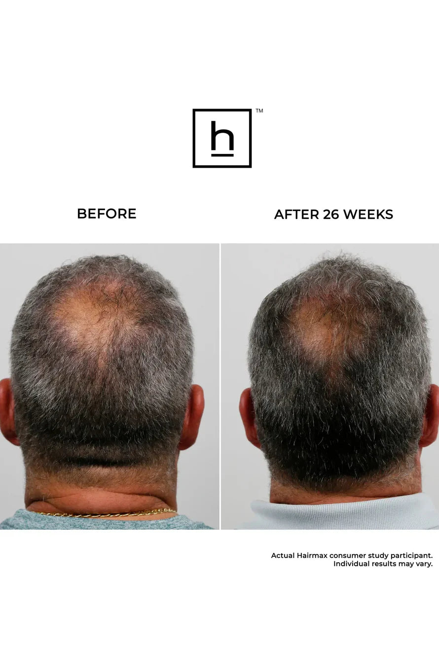 HairMax ULTIMA 9 LaserKam