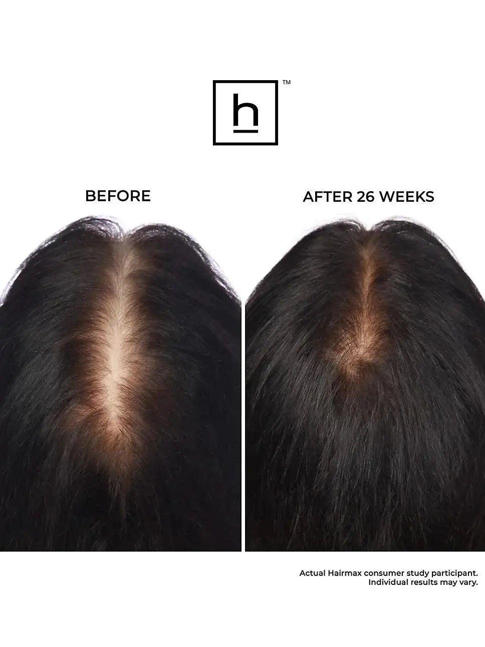 HairMax LaserBand 82 ComfortFlex