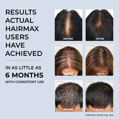 HairMax LaserBand 82 ComfortFlex