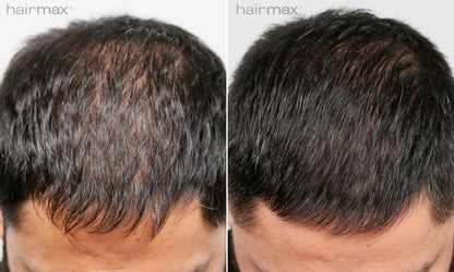 Hairmax Laserkam Ultima 12 2.0